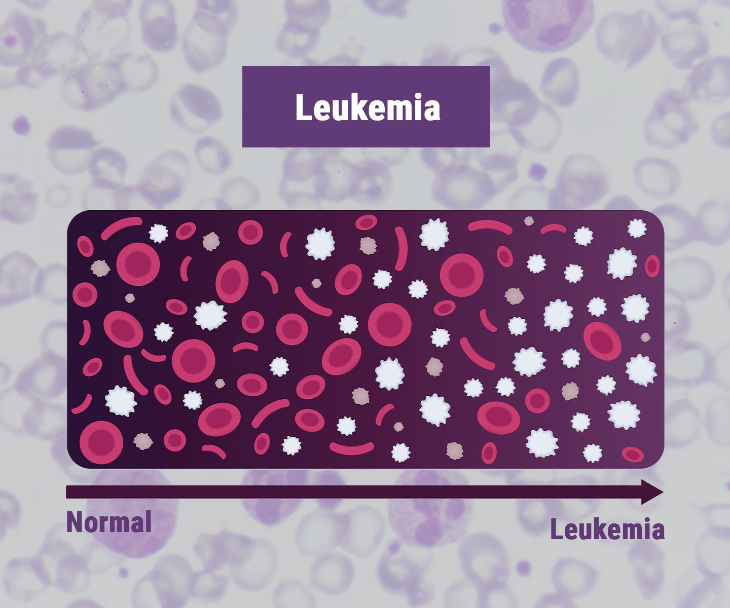 Leukämie Leukämie
