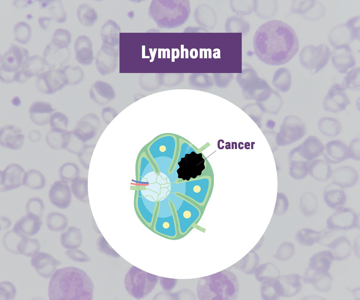 Lymphom Lymphom